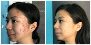 microneedling for acne