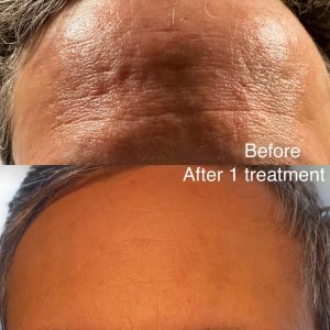 microneedling results after one session